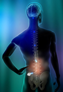 Spinal Cord Stimulators, Chronic Back Pain Canada